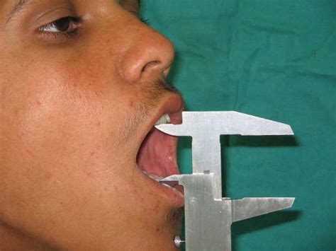 Photograph Of Pre Operative Measurement Of Mouth Opening By Boley Gauge