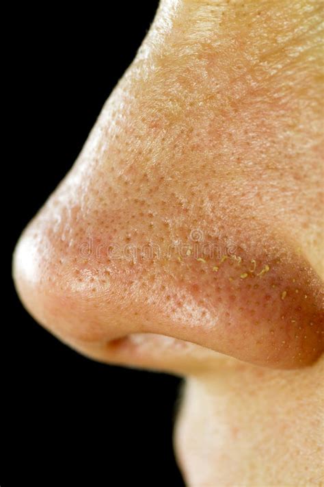 Fatty Nose Pores Stock Photo Image Of Blackheads Pores 23502214