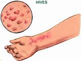Pictures of Chronic Hives Home Remedies
