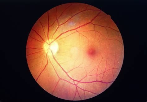 Macular Hole Vitrectomy Retina Specialists Of Michigan