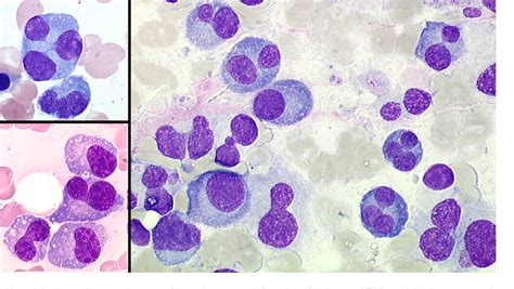 Figure 8 From Plasma Cell Morphology In Multiple Myeloma And Related