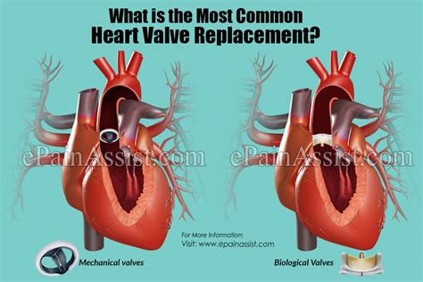 What Is The Most Common Heart Valve Replacement