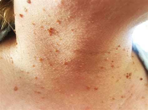 Skin Growths And Spots Lumps And Bumps Assurance Skin Images And