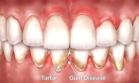 Difference Between Gingivitis And Advanced Periodontal Diseases