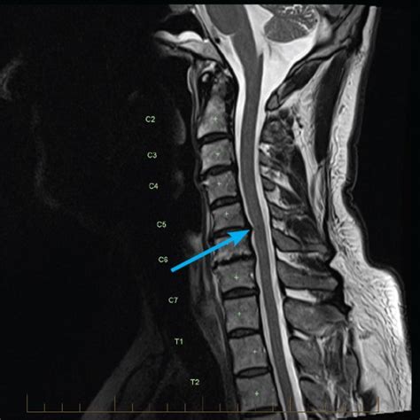 Adult Mri Series Cervical Spine Trauma