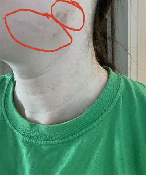 Recurring Cyst On Jawline For Years Now An Enlarged Vein Any Idea