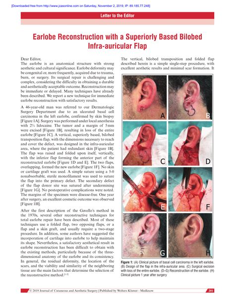 Pdf Earlobe Reconstruction With A Superiorly Based Bilobed Infra