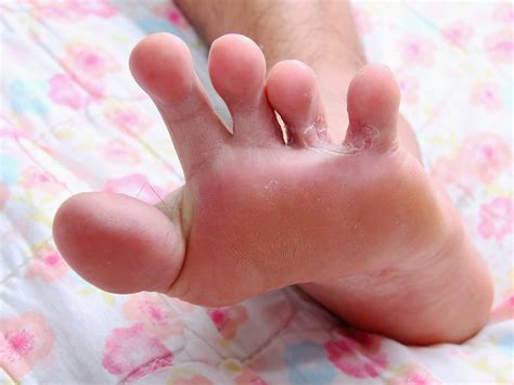 Childhood Rashes Skin Conditions And Infections Photos Babycenter