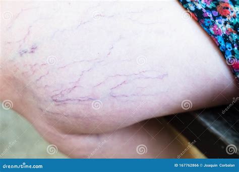 Detail Of Varicose Veins On The Leg Of A Seated Woman Stock Photo