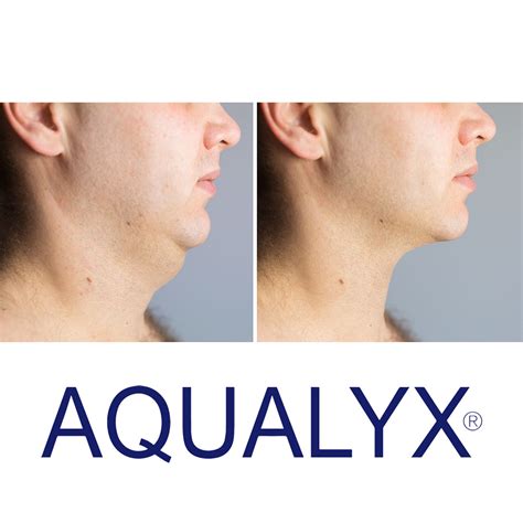 Aqualyx Fat Dissolving Injections Ny Beauti