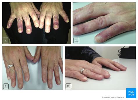 Raynauds Syndrome Signs Symptoms Causes And Treatments Kenhub
