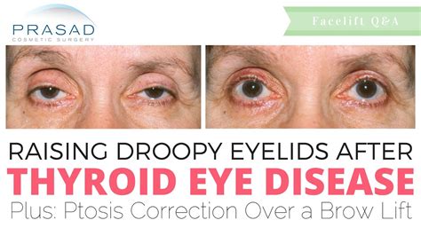 First Symptoms Of Graves Eye Disease Recognize Disease