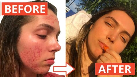 My Accutane Experience Before And After Pics Youtube