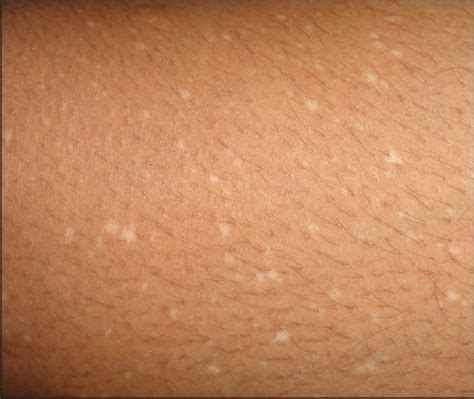 Confetti Skin Lesions