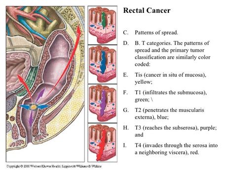 Colon And Rectal Cancer