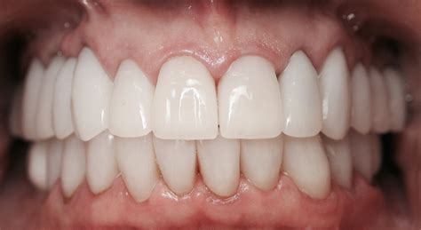 Dental Case Study 38 North Shore Restorative And Implant Dentistry