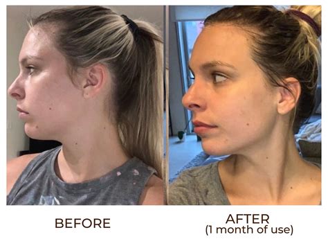 Gua Sha Jawline Before And After Before And After