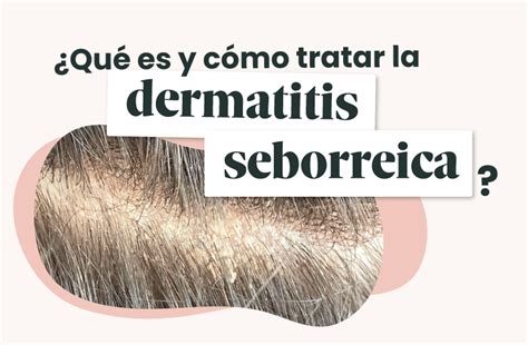 ¿qué Es Y Cómo Tratar La Dermatitis Seborreica