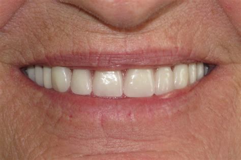 Dentures Smile Gallery Raber Dental Kidron Dentist