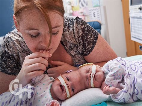 The Incredible Survival Story Of Twins Who Underwent One Of The Rarest