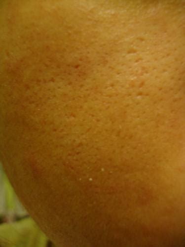 Extremely Large Pores Or Acne Scars Pics Included General Acne