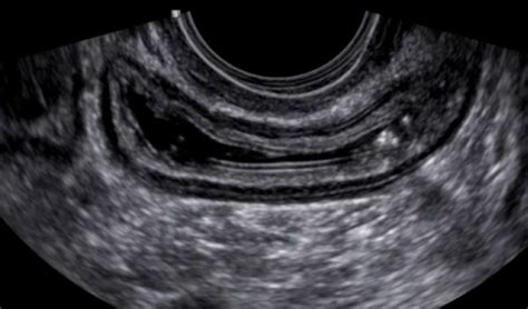 Exame De Ultrassom Transvaginal Para O Diagnóstico Da Endometriose