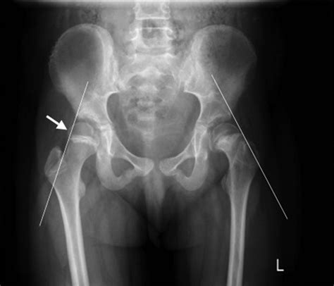 Hashimotos Hypothyroidism Presenting With Sufe Slipped Upper Femoral