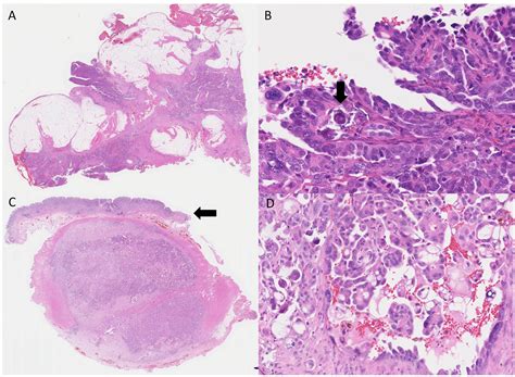 A Primary Peritoneal Serous Carcinoma Metastasizing To The Stomach