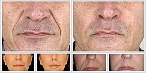 Nasolabial Folds Surgery Remove Deep Laugh Lines Around The Mouth