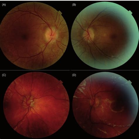 Optical Coherence Tomography Oct Of The Optic Nerve Head Reveals