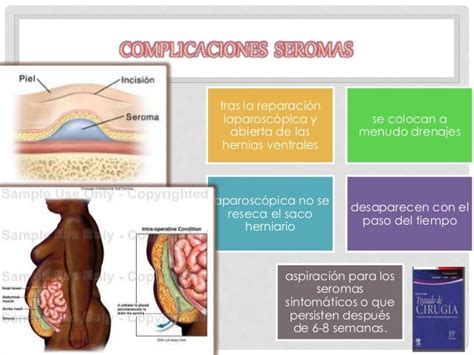 Hernias Pared Abdominal Anterolateral Y Lumbar