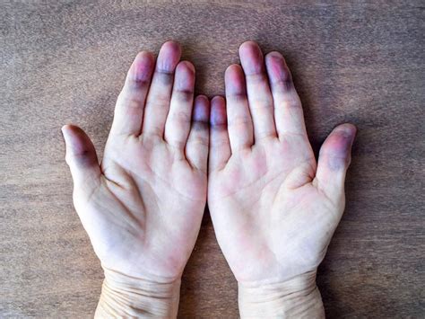 What Causes Discoloration Of Hands And Lips