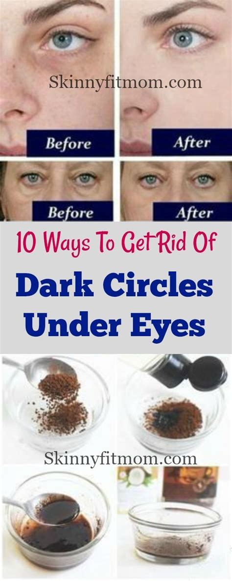 Natural Home Remedies To Get Rid Of Under Eyes Dark Circles 10 Fast