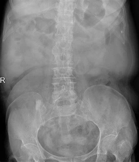 Plain Abdominal X Ray Shows Normal Bowel Gas Pattern Download