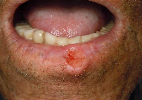 Úlcera En Semimucosa Labial Inferior Y Borde BermellÓn En Paciente Con