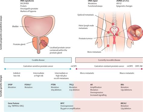 Prostate Cancer The Lancet