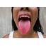 If Your Tongue Looks Like This You May Have COVID  BlackDoctororg
