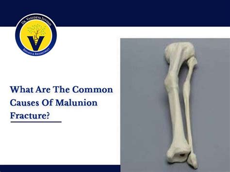 Malunion Fracture Causes Dr Vasudev Explains Comprehensively