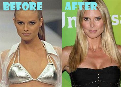 Heidi Klum Plastic Surgery Before And After Pictures