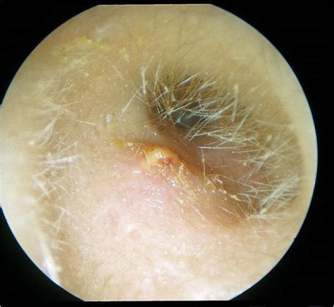 Otitis Externa Outer Ear Infection Or Swimmers Ear Dr