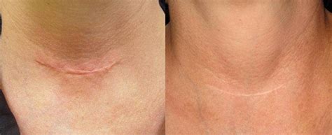 Micro Needling Before And After Results Fairfax Va Impressions Medspa