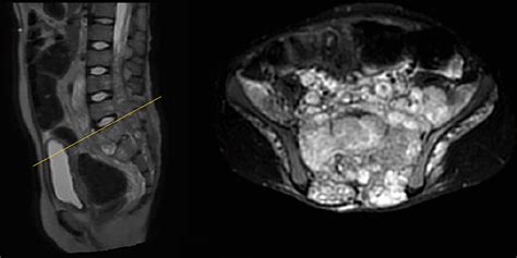 Axial And Sagittal Mri Showing The Extension Of The Lumbosacral