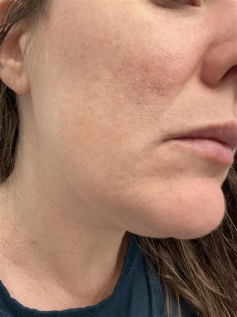 What Can I Do To Treat My Rednesslarge Pores Textureive Tried Ipl