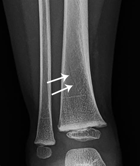 Its Tough Being A Kid Toddlers Fracture Radiology Key