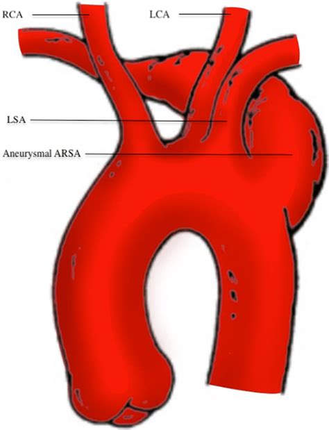 An Aberrant Right Subclavian Artery Depicted With Aneurysmal Dilatation