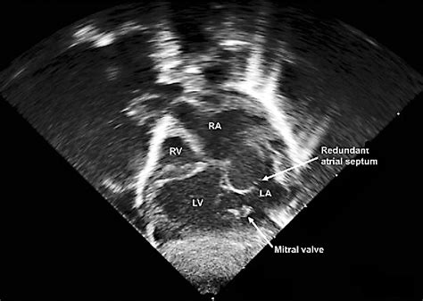 Figure 2 From Prenatal Diagnosis Of Dextrocardia With Complex