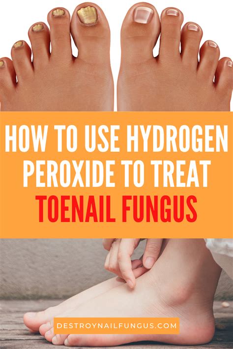 Does toenail fungus go away by. The Efficacy of Vinegar and Hydrogen Peroxide in Treating ...