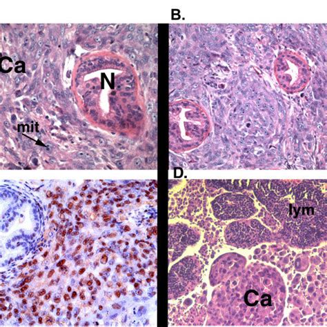 Upar Positive Cells In Prostate Cancer Vs Lymph Node Metastases 200×