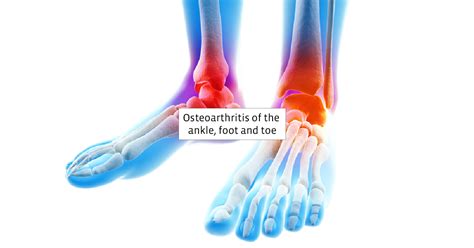 Arthritis In Ankle Foot Or Toe Treatments And Exercises
