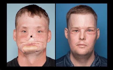 3d Drucker Ermöglichen Gesichtstransplantation Bei 32 Jährigem Mann